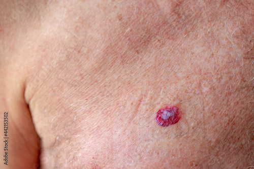 Health care concept, Close up a european senior man with red spot on the right chest, Basal-cell carcinoma (BCC) also known as basal-cell cancer is the most common type of skin cancer. photo