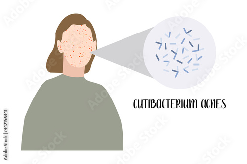 Cutibacterium acnes, Propionibacterium. Gram-positive bacteria. Acne, inflammatory skin disease, skin rashes and pimples on face, allergy. Dermatology. Vector flat cartoon illustration