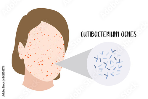 Cutibacterium acnes, Propionibacterium. Gram-positive bacteria. Acne, inflammatory skin disease, skin rashes and pimples on face, allergy. Dermatology. Vector flat cartoon illustration