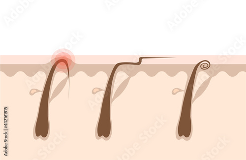 Types of ingrown hairs flat illustration. Cross section of the human skin with hair follicles. Hair removal concept.Can be used for topics like shaving, depilation, cosmetology photo