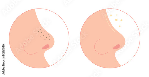 Blackheads on nose cleaning flat illustration. Washing face with clogged pores. Blackheads removal, skin cleaning, skincare. Can be used for topics like cosmetology, cosmetics. Shrinking and minimaizi