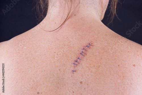 Stitches on the back of a woman after and operation to remove a mole