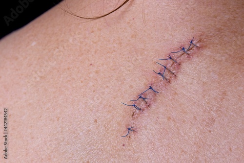 Stitches on the back of a woman after and operation to remove a mole