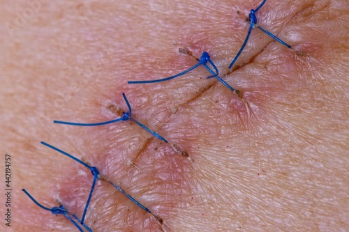 Stitches on the back of a woman after and operation to remove a mole