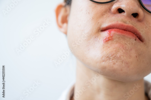 Herpes labialis of the woman lower lip with isolated copy space. Blisters that break open and form small ulcers, swollen lymph nodes. Herpes simplex virus is an infection that causes herpes.
