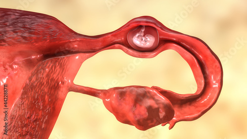 Tubal ectopic pregnancy, 3D illustration photo