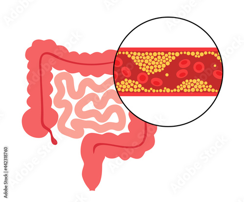 Mesentric ishemia disease