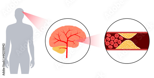 Brain stroke ishemic