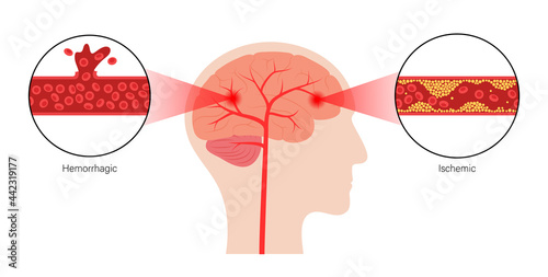 Brain stroke ishemic and hemorrhagic photo