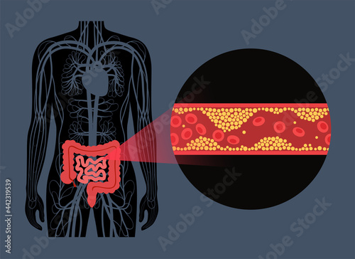 Mesentric ishemia disease
