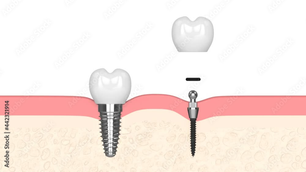 Comparison of two types dental implants