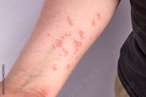 Large rash on the guy's hand. Monkeypox virus photo