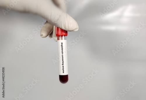 Test Tube with blood sample for  Angiotensin-converting enzyme (ACE) test. diagnosis of sarcoidosis. A medical testing concept in the laboratory. photo