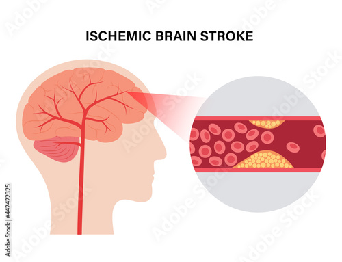 Brain stroke ishemic