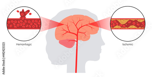 Brain stroke ishemic and hemorrhagic