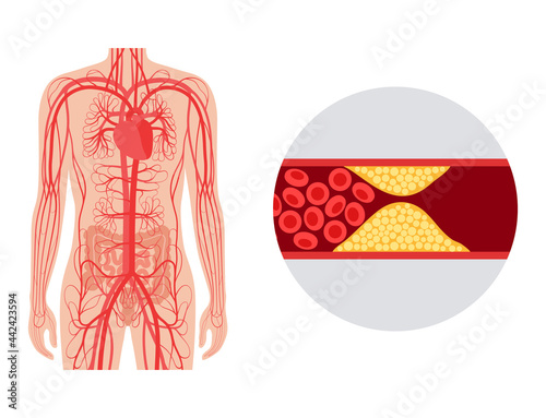 Mesentric ishemia disease