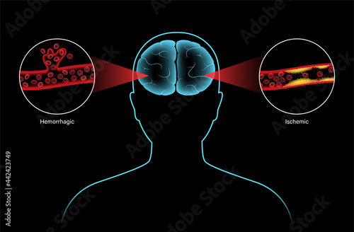 Brain stroke ishemic and hemorrhagic