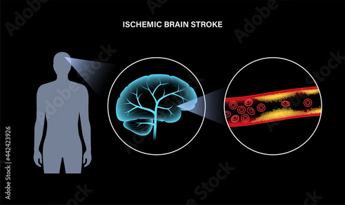 Brain stroke ishemic