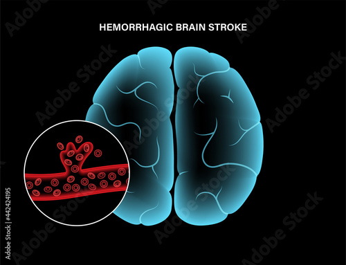 Brain stroke hemorrhagic photo