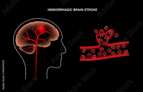 Brain stroke hemorrhagic