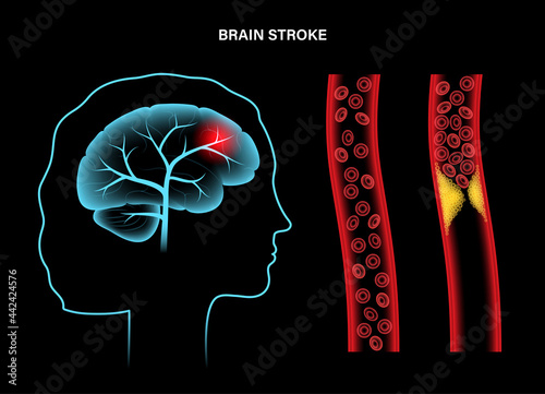 Brain stroke ishemic