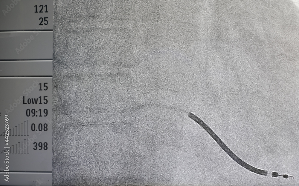 Foto de x-ray image of permanent pacemaker implant in chest body do ...