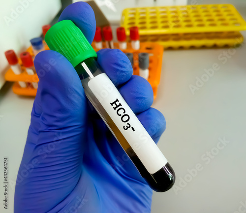 Biochemist or technician hold blood sample for HCO3- (bicarbonate ion) test. blood gas test photo