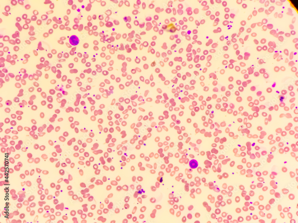 Iron deficiency Hypochromic microcytic anemia, red blood cells in a👹 ...