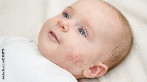 Portrait of cute little baby with red skin suffering from acne or dermatitis. Concept of newborn baby hygiene, health and skin care