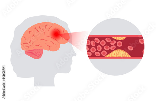 Brain stroke ishemic