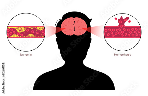Brain stroke ishemic and hemorrhagic