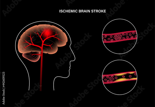 Brain stroke ishemic