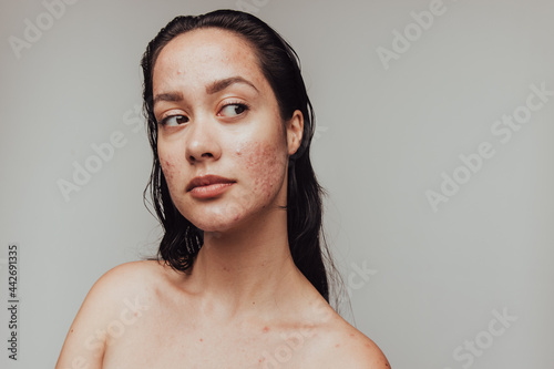 Close up of woman with acne inflammation photo