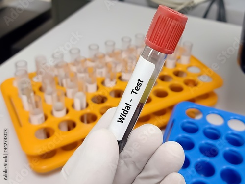 Foto Test Tube with blood sample for Widal test, diagnosis of typhoid fever