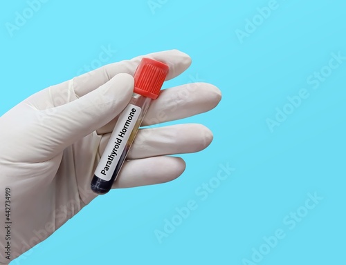 Biochemist or Doctor holds Blood sample for Parathyroid Hormone (PTH) test. Diagnosis for organ disease. Medical testing concept. photo