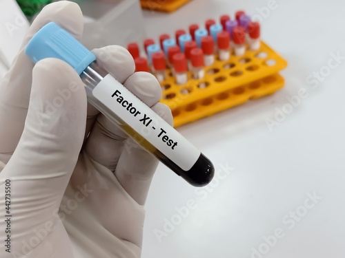 Obraz na plátně Biochemist or Lab Technologist holds Blood samples for factor XI or plasma thromboplastin antecedent diagnosis of coagulation disorder test in the laboratory background
