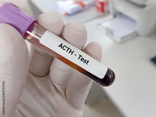 Biochemist or Lab Technologist holds Blood sample for Adrenocorticotropic hormone (ACTH) test, diagnosis of Addison's disease with laboratory background. photo