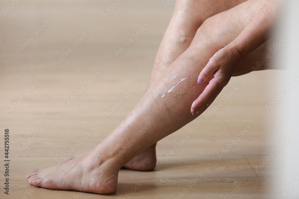 Painful varicose and spider veins on active womans legs, self-helping herself in overcoming the pain. Vascular disease, varicose veins problems, active life concept. Painful varicose and spider veins on active womans legs, self-helping herself in overcoming the pain. Vascular disease, varicose veins problems, active life concept.