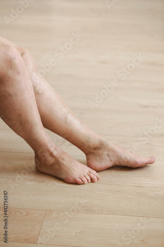 Painful varicose and spider veins on active womans legs, self-helping herself in overcoming the pain. Vascular disease, varicose veins problems, active life concept. © Andriy Medvediuk