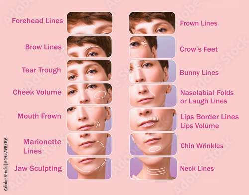 Treatment areas for anti-wrinkle injection.