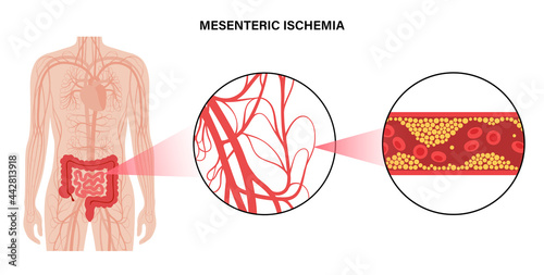 Mesentric ishemia disease