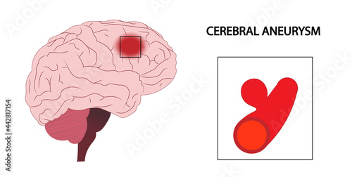 Cerebral Aneurysm. Artery aneurysm illustration photo