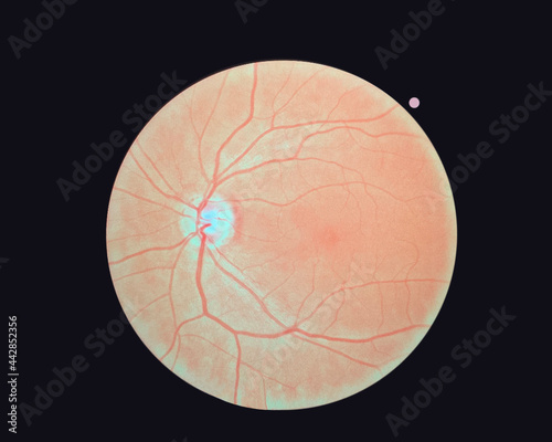 Right eye's retinal image isolated on a black background.