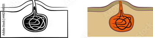 Pilonidal cyst icon , vector illustration
