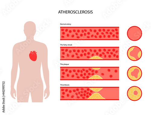 Cholesterol heart disease
