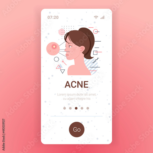 acne on woman face pore comedones cosmetology skincare problems treatment skin disease concept smartphone screen mobile app portrait