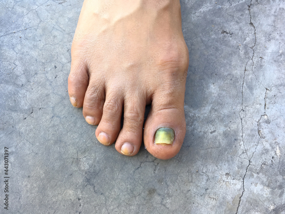 Discolouration of nails after chemotherapy. Side effects from breast