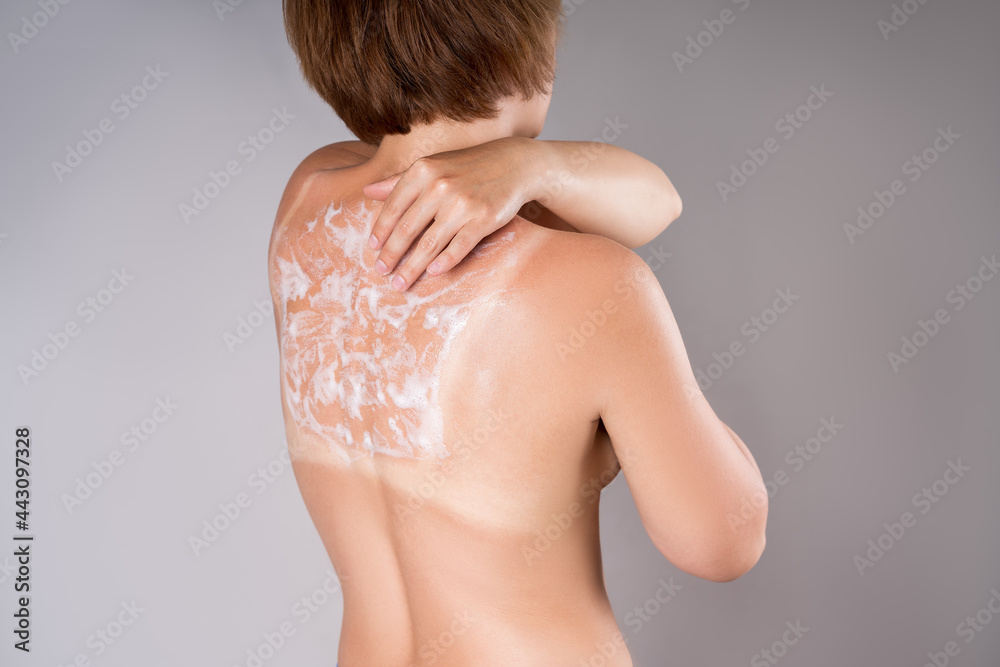 A tanned woman applies sunscreen to her back, sunburn marks on the body