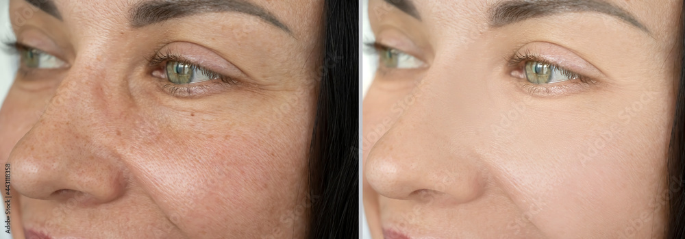 woman eyes wrinkles before and after treatment