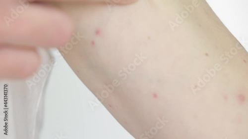 Body of adult  man have spotted, red pimple and bubble rash from chickenpox or varicella zoster virus